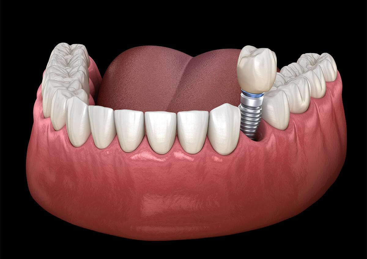 How Long Do Teeth Implants Last in Battle Creek MI Area